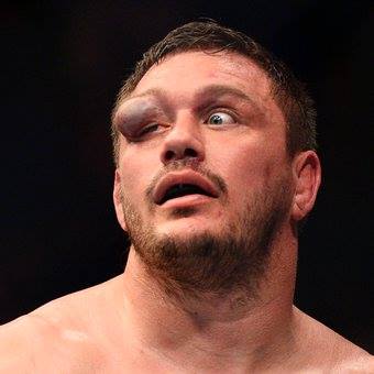 Matt Mitrione's eye swells during a recent fight with Travis Browne