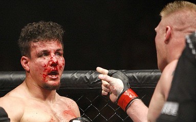 A bloody Frank Mir after rematch with Brock Lesnar at UFC 100.