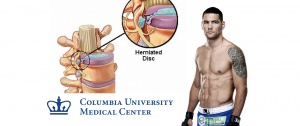 Chris Weidman will undergo surgery on herniated discs on Wednesday at Columbia University Medical Center